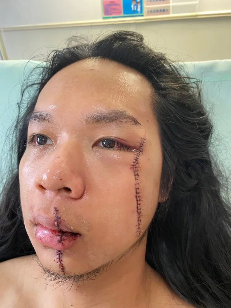 長髮哥臉上留下2道超長傷口。讀者提供