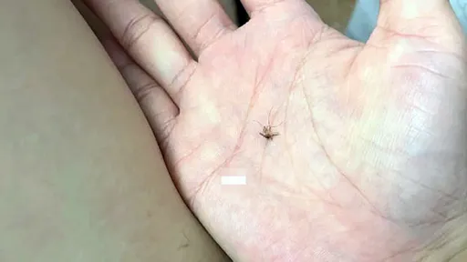 打蚊子竟把自己打到骨折 35歲女患傻眼:不會這麼誇張吧