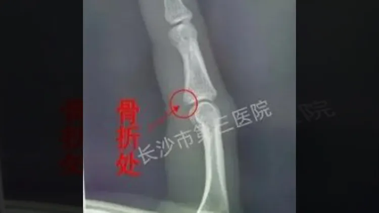 李女因為打蚊子而手指骨折。翻攝自《頭條新聞》