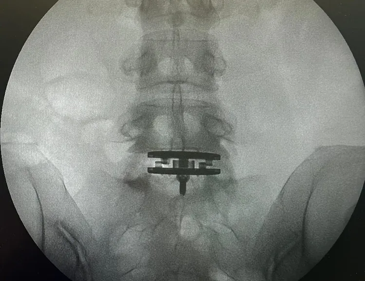 徐濠縈換了人工椎間盤。翻攝hilaryxtsui IG