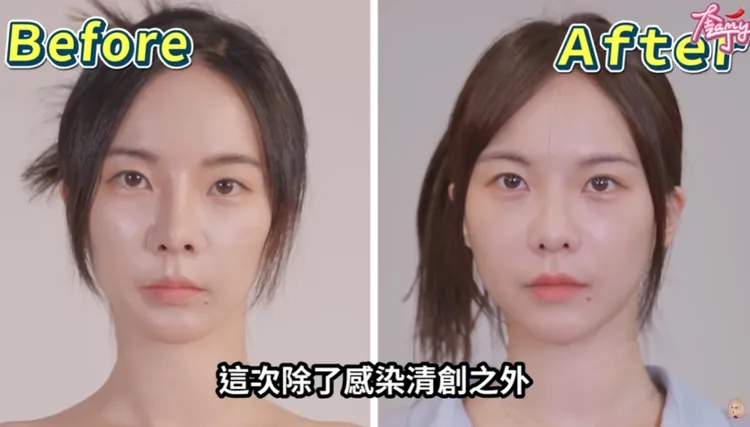 奎丁除了開刀清創，還用自體肋骨重建了她的鼻子，秀術前術後成果。翻攝奎丁YT影片