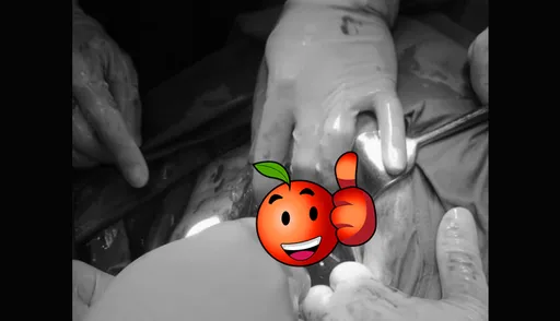 雙胞胎破水「寶寶伸出求援的手」畫面曝光 網友讚嘆:好感動的一刻