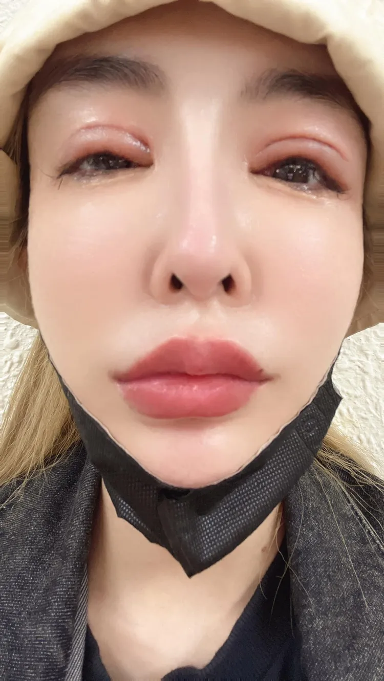 方祺媛（雪碧）在臉書貼出雙眼紅腫的照片。翻攝自方祺媛臉書專頁。