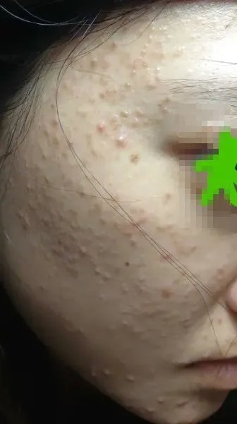 女網友身體斷斷續續出現長癬跟濕疹，經愛滋篩檢2次都中獎。翻攝Dcard