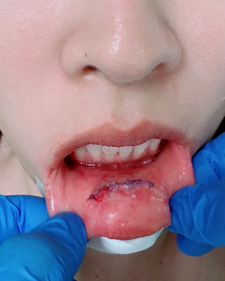 小嫻受傷後掛急診，縫嘴唇。翻攝小嫻IG