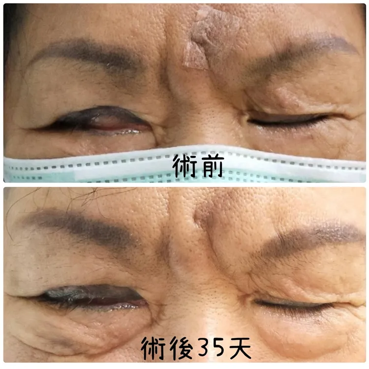 患者術後可自然閉合右眼。光田醫院提供