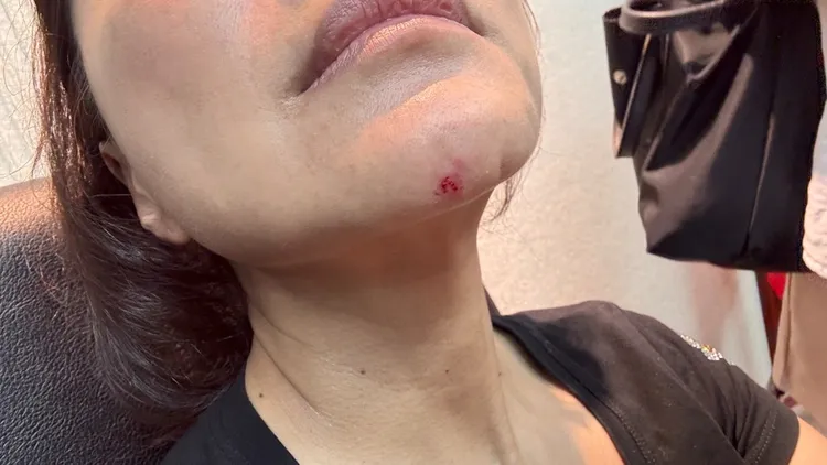 林楚茵指控王鴻薇打她巴掌到見血。林楚茵辦公室提供