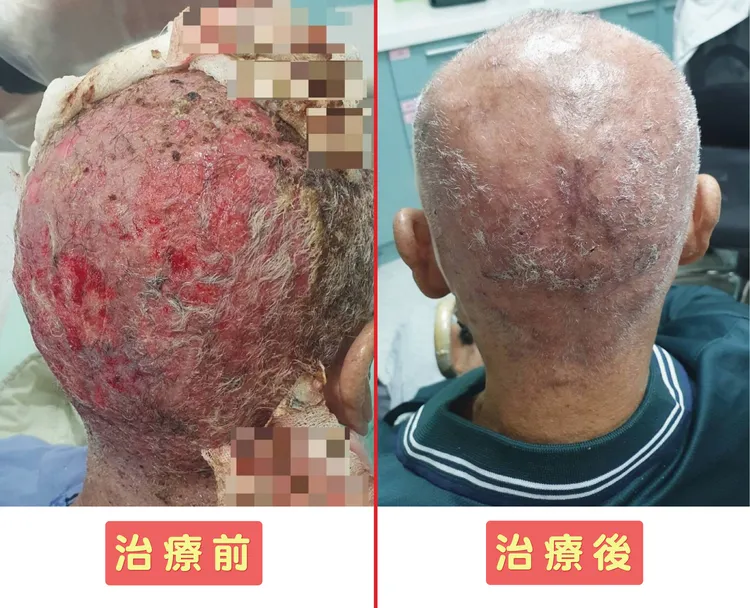 患者經藥物治療，並立即停用原本的口服標靶藥物，2週後頭皮煥然一新。烏日林新提供