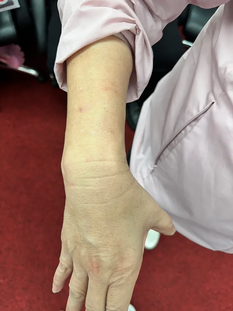 賴惠員還被抓出好幾處抓痕。翻攝賴惠員臉書