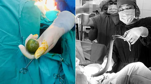 65cm活鰻魚鑽肛不夠嗨　31歲男還「檸檬封菊花」險讓自己沒命