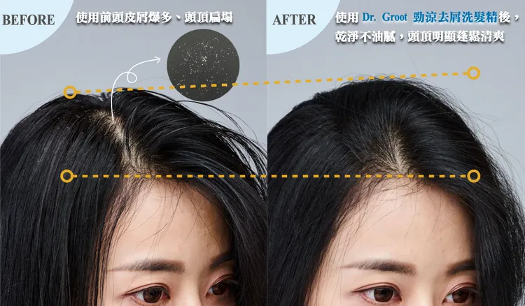 ▲ 夏天最容易出油生屑的頭頂頭皮，使用後頭皮屑明顯消失，油感也不見，頭頂蓬鬆度直接UPUP。