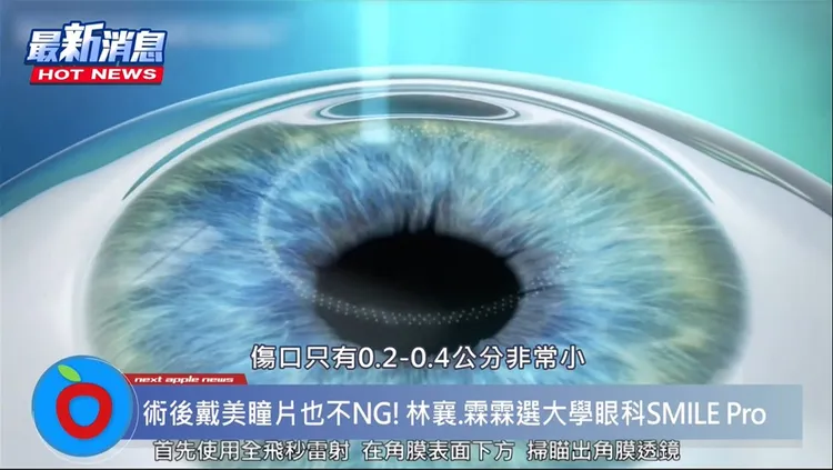 SMILE Pro全飛秒近視雷射手術，傷口僅需0.2-0.4公分大小，傷口小恢復期短。