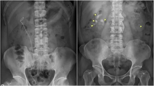 54歲男右側腎臟結石 奇美醫院「可彎式輸尿管鞘」有效剋星