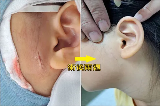 手术伤口可沾水淋浴 医疗级「皮肤组织胶」表皮缝线新选择