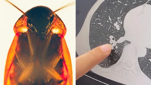 超噁！他頻頻咳嗽竟是「蟑螂鑽進鼻孔抵達氣管」