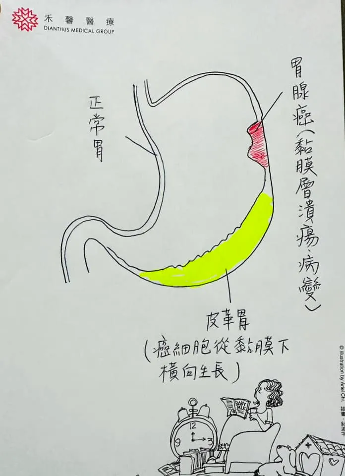 皮革胃圖解。取自肝膽腸胃科 詹宜學醫師粉專