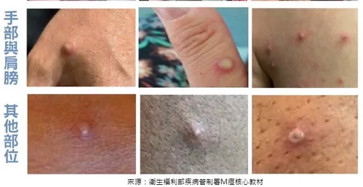 台中新增1例本土M痘確診 符合「3條件」盡速接種2劑疫苗