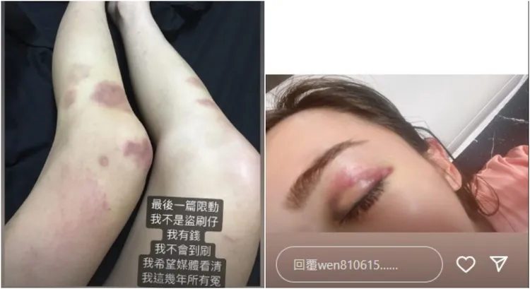 罔腰曬出被打的傷勢照。翻攝罔腰IG