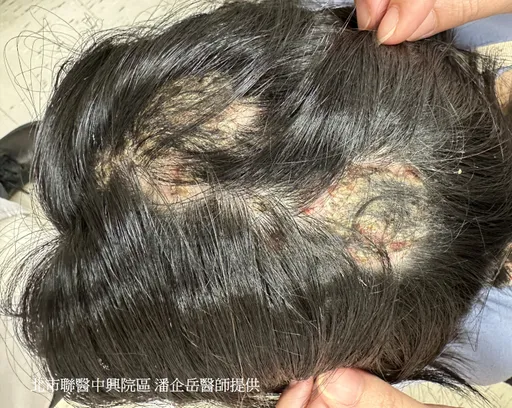 8歲女童頭皮化膿落髮竟是「這病」 生瘡、斷髮莫輕忽