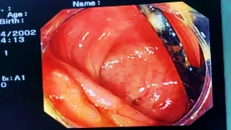 內視鏡顯示男子腸壁穿孔。翻攝自《廣州日報》