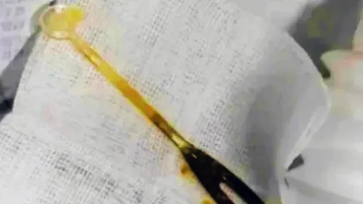 他腹痛3月竟是「8cm塑膠叉子刺入腸壁」 入肚原因太離譜