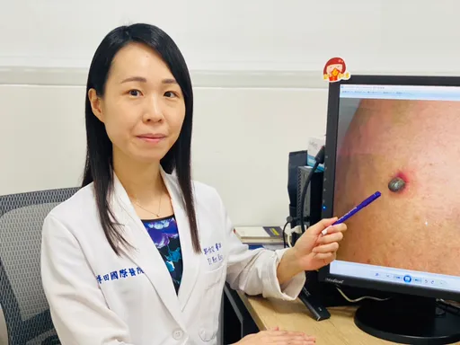 老翁游日返国小腿突冒息肉 就医才知蜱虫跟回台