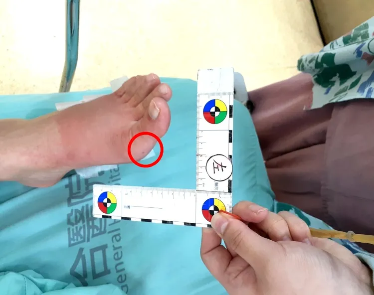 吳小姐遭咬傷處。光田醫院提供