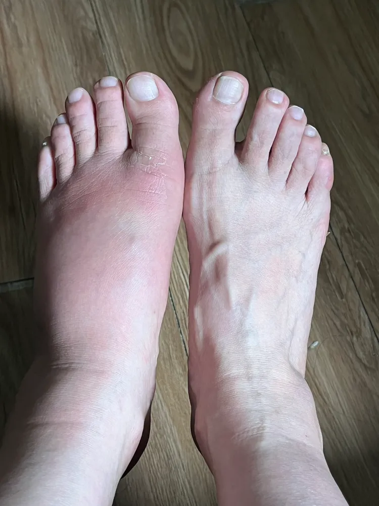 吳小姐左腳遭眼鏡蛇咬傷後，傷口嚴重紅腫。吳小姐提供