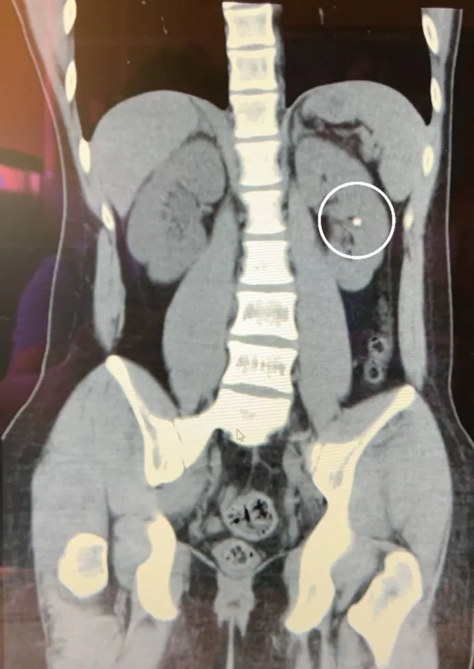 19歲「少年仔」因為少喝水、憋尿，年紀輕輕就結石，造成右腎積水，經常腰酸背痛。阮綜合醫院提供