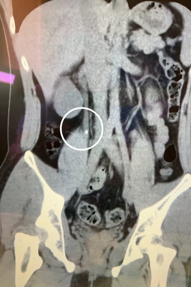 經過手術取出結石後，小周也恢復健康。阮綜合醫院提供
