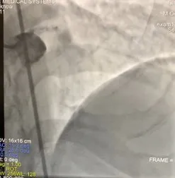 患者到院後醫師進行心導管檢查，發現左冠狀動脈完全阻塞。台中醫院提供