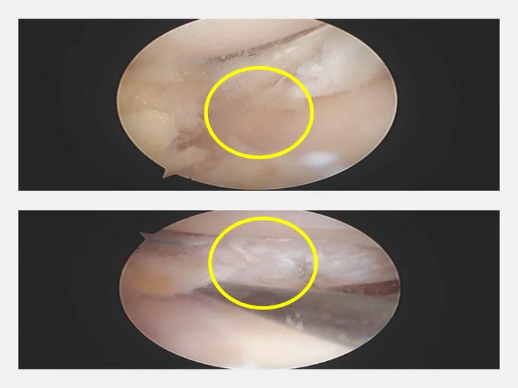 患者手術前病患膝蓋外側半月板破裂（上圖圓圈處）；手術後已修補膝蓋外側半月板。大里仁愛醫院提供