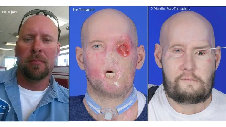 左圖為詹姆斯在意外前模樣；中間為在意外後受傷的模樣；而右圖為經歷人臉移植手術後的臉部。翻攝自People