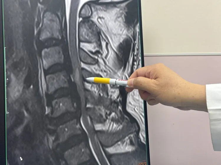 患者跌倒後發現罹患後縱韌帶骨化症，頸椎脊髓有水腫。李綜合醫院提供