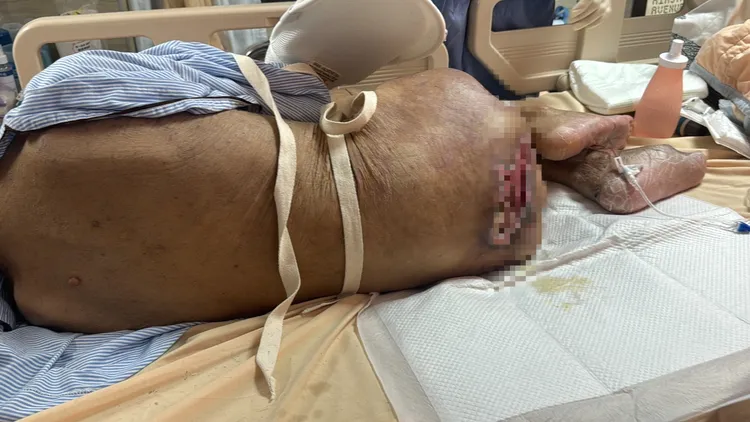 住院治療後臀部褥瘡已逐漸好轉，但吳阿嬤身體仍非常虛弱。讀者提供