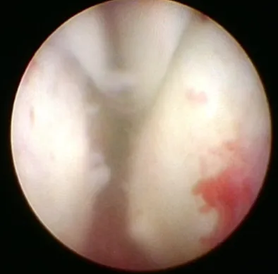 患者術前攝護腺肥大阻塞排尿。童綜合醫院提供