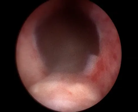 術後攝護腺暢通使排尿正常。童綜合醫院提供