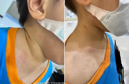 台中又有幼兒園出事!男童被掐嘴、拉扯多處傷 女師遭停職調查