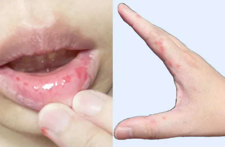 腸病毒典型症狀為口腔、手掌、腳掌出現水泡、潰瘍。基隆部立醫院提供