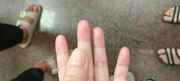 女童手部有紅腫、瘀青，疑似被教保員用力扭手導致。民眾提供