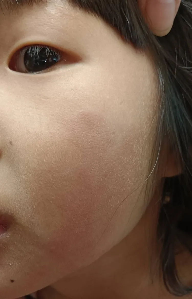 女童臉部紅腫，機構辯稱是替女童按摩，避免她吃蘋果噎到。民眾提供