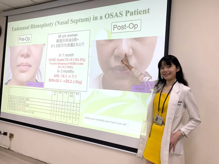 季照芸說明「功能性暨美觀性鼻整形手術」術後立即照，個案治療前（左）後（右）。台中醫院提供
