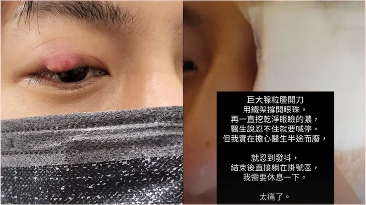 邱昊奇眼皮霰粒腫開刀沒辦法上麻藥。翻攝自邱昊奇臉書