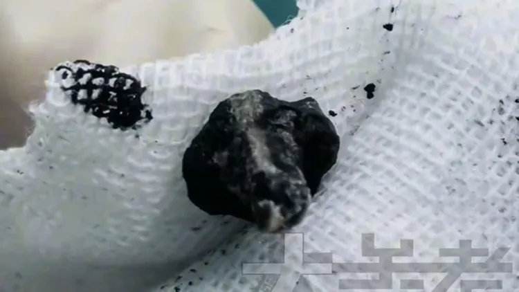 從男童鼻腔內取出的金屬螺絲釘。翻攝自《大參考》