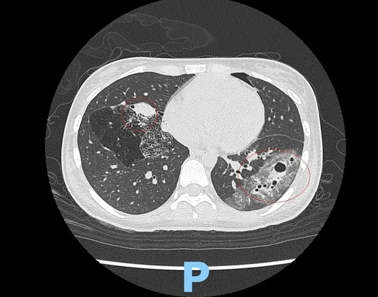 電腦斷層發現黃姓少女左右2肺都有大囊泡、囊腫。彰化醫院提供