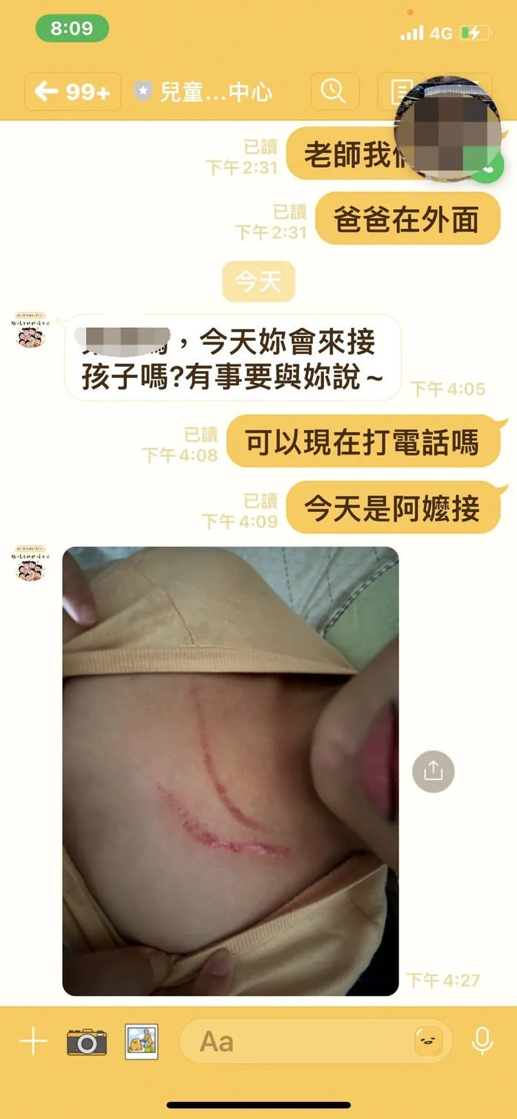 幼兒園通知家長男童出現傷痕。家長提供