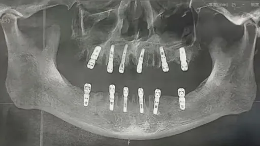 1天之內「拔牙23顆、植牙12顆」　他疼痛13天心臟驟停喪命