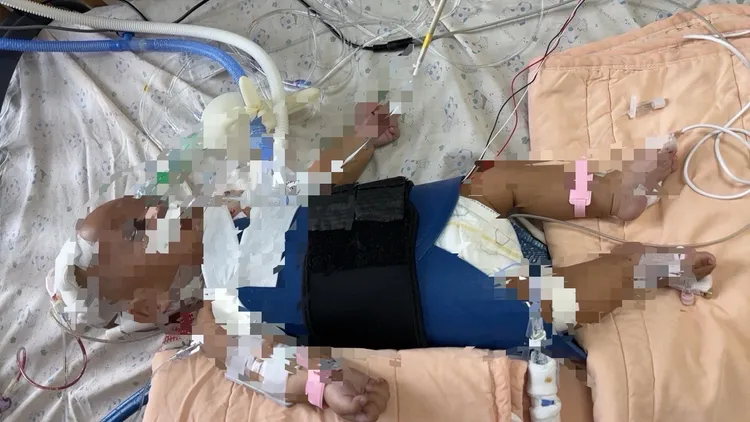 陳小弟到院前就沒了呼吸心跳，經急救及開刀，目前瀕臨腦死，家屬決定不讓他繼續受苦。家屬提供