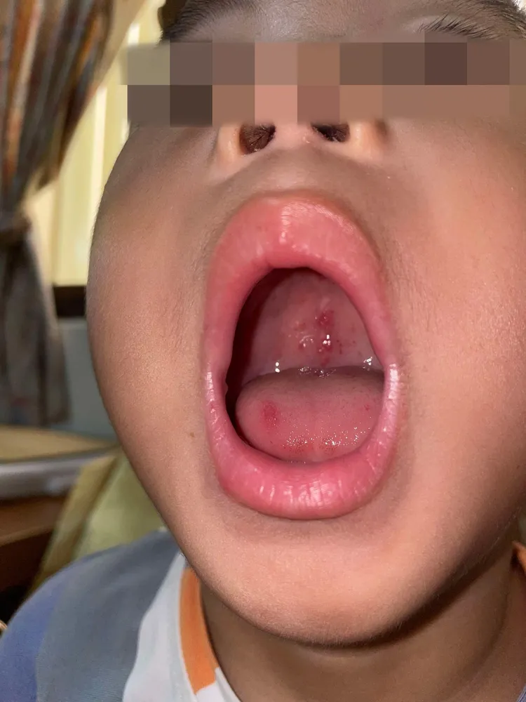 腸病毒會造成口腔、手掌出現水泡、潰瘍，常會讓小朋友難以進食。亞大附醫提供