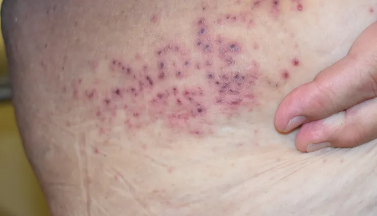 6旬婦人有三高，某天帶狀疱疹發作，不僅長滿全身多處更疼痛難耐。院方提供